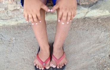 Victor Soares, de 8 anos, sofre de polidactilia e tem 26 dedos