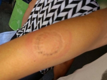Estudante de 14 anos mordeu brao de professora, segundo polcia (Foto: Arquivo pessoal)