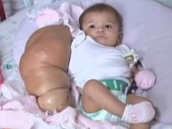 RJ: Beb� com bra�o gigante, � internada com infec��o; v�deo