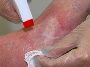 Pel�cula desenvolvida em S�o Carlos favorece a cicatriza��o de feridas