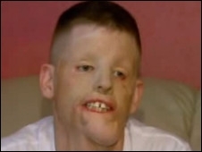 Hunter ser o terceiro paciente a receber transplante de rosto nos EUA