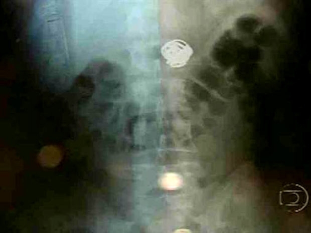 Raio-x mostra joias dentro do corpo de assaltante que engoliu as peas aps assalto