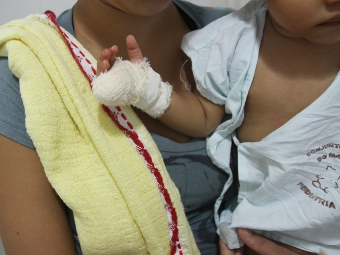 Beb teve parte do dedo cortado em hospital de So Paulo e continua internada, devido a uma crise de anemia falciforme