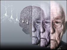 Representao grfica mostra o crebro de um paciente de Alzheimer