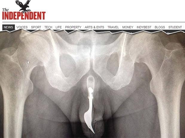 Imagem do raio-x do australiano antes da cirurgia