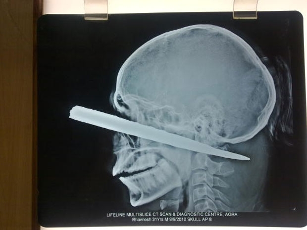 Indiano sobrevive aps cair e ter barra de metal cravada entre os olhos