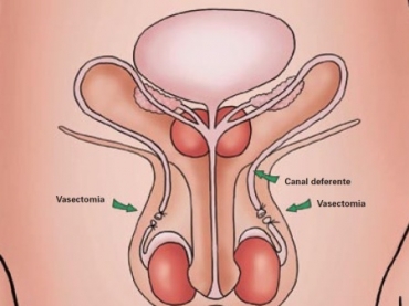 Na vasectomia, os canais deferentes so cortados, o que impede a chegada dos espermatozoides ao smen