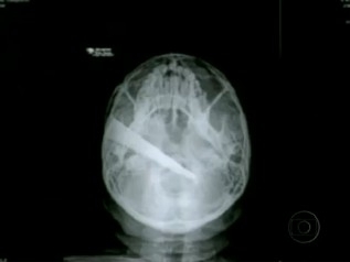 Aps 2 meses, faca  retirada de cabea de vendedor em SC