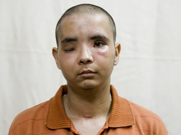 Indiano sofre 100 fraturas na cabea e tem face reconstruda por mdicos