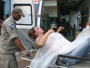 Mulher teve com 30% da parte superior do corpo queimado