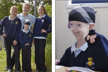 Calv�cie e cr�nio grande s�o caracter�sticas da doen�a