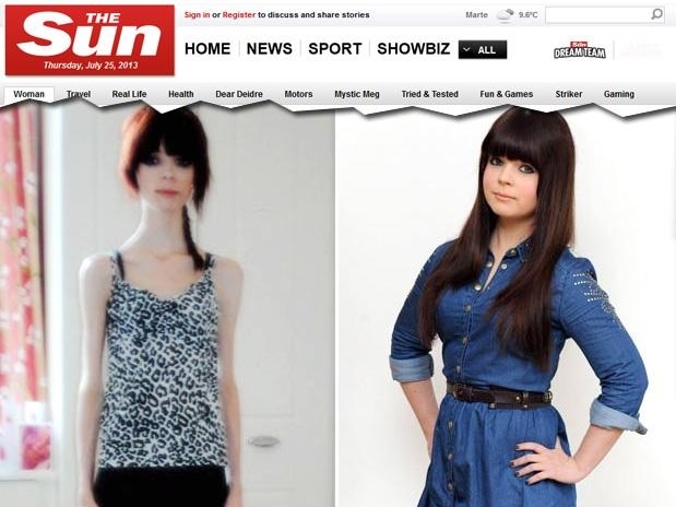 Jovem britnica pesava 28,5 Kg quando sofreu uma parada cardaca