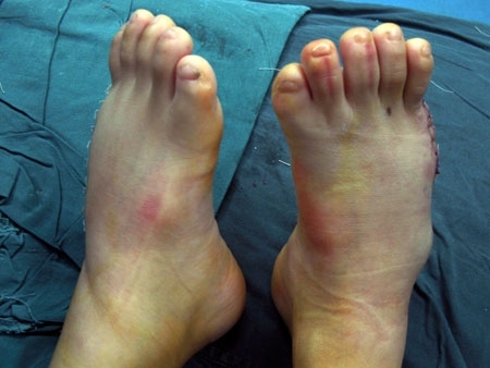 Ps do menino perderam o excesso de dedos, assim como as mos