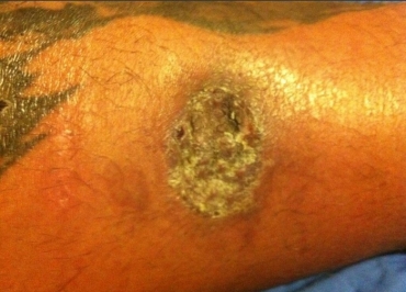 O peso-pesado Mark Hunt deve retornar aos treinos em poucas semanas