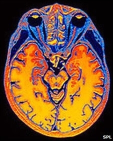 Exames revelaram de qual filme o voluntrio estava se lembrando