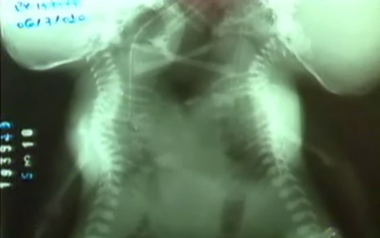 Adolescente de 14 anos d� � luz g�meas siamesas