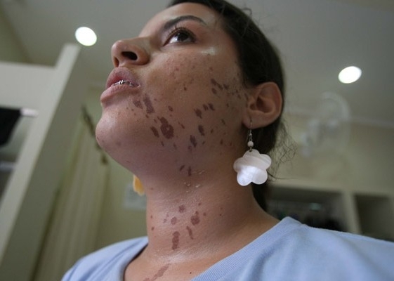 Estudante sofreu queimaduras no rosto aps trote violento no interior de SP.