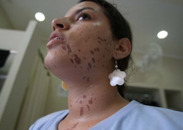 Estudante sofreu queimaduras no rosto aps trote violento no interior de SP.