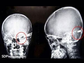 Bala alojada na cabea de Cabaas