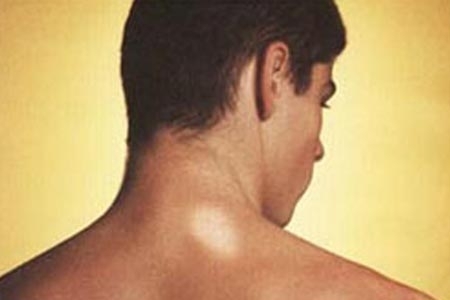 Mato Grosso  o quinto no ranking nacional em casos de hansenase