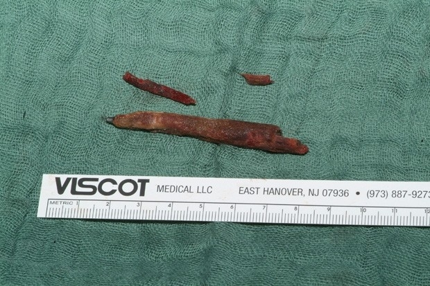 Lpis com 7 cm de comprimento foi retirado do crebro de jovem aps 15 anos