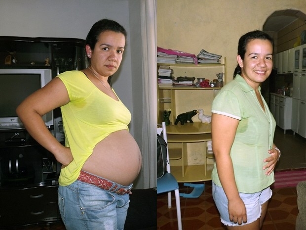 Jovem mostra resultado da cirurgia que retirou cisto gigante