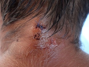 Pescador escapa de ataque de crocodilo na Austr�lia