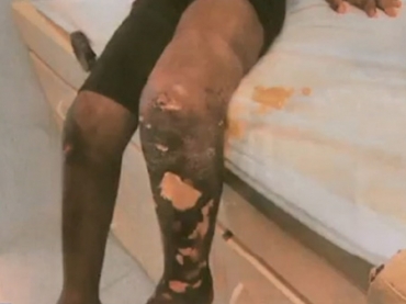 As pernas ficaram com ferimentos graves