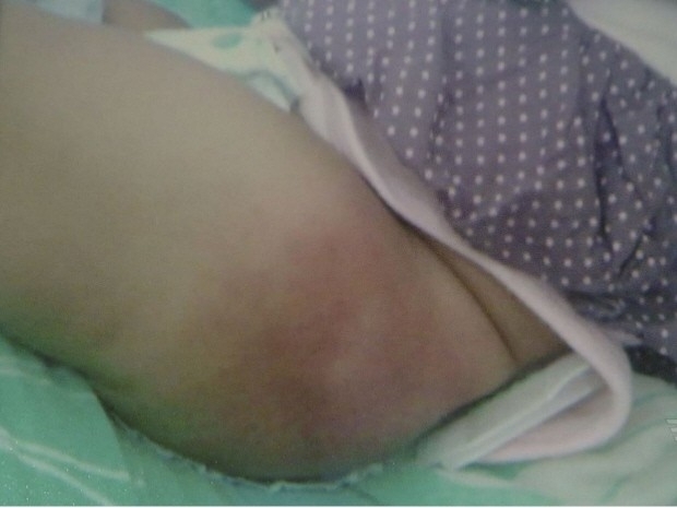 Vacina causou vergo na perna do beb de quatro meses