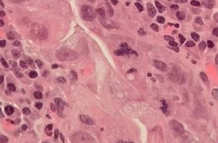 Novo exame poderia diferenciar se o cncer no estmago est em fase inicial ou estgio avanad