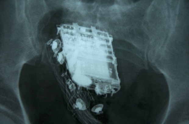 Raio-X mostra o telefone celular no reto de prisioneiro de 58 anos em Colombo, no Sri Lanka