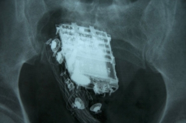 Raio-X mostra o telefone celular no reto de prisioneiro de 58 anos em Colombo, no Sri Lanka