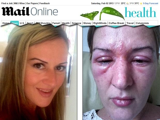 Jane Rolfe sofreu uma severa reao alrgia  cola do alongamento de clios