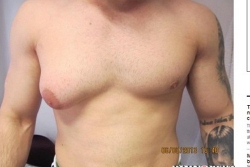 Hashemzadeh sofreu com ginecomastia, o alargamento do tecido mamrio em homens