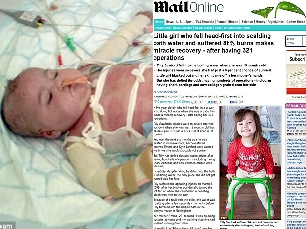 Tilly teve 86% do corpo queimado e se recuperou aps 321 cirurgias