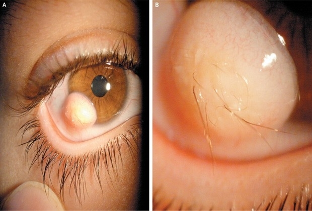 Tumor com pelos identificado no olho de paciente