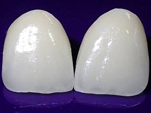Lentes de contato para dentes tm at 0,4 mm e podem corrigir irregularidades