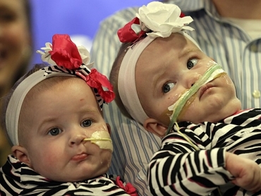 Alisson e Amelia aparecem em pblico pelas primeira vez aps cirurgia de separao