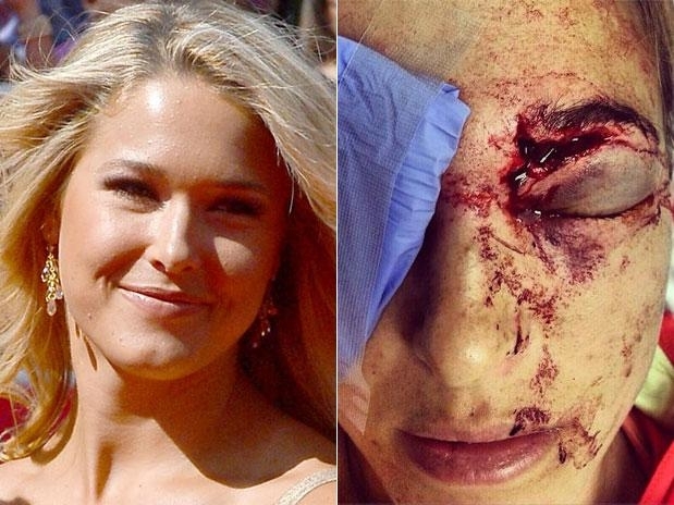 Mogan Beck levou bolada de marido, o esquiador Bode Miller, e publicou imagem da direita no Instagram