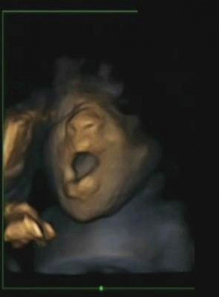 Imagem mostra claramente o bocejo de um feto