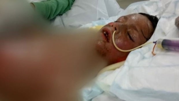 Calvin teve bolhas no rosto em reao a um medicamento