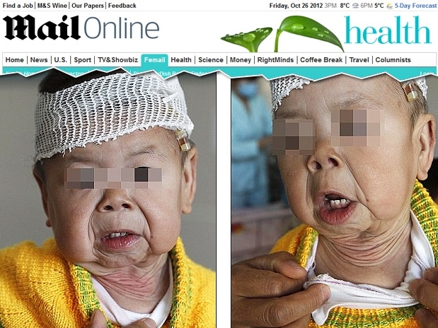 Yuxin sofre de ctis laxa, uma enfermidade do tecido conjuntivo na qual a pele se torna inelstica