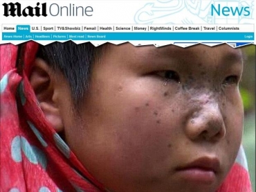 Menina teve 68 peda�os de metal em seu rosto ap�s o acidente; tr�s meses depois, as marcas ainda s�o vis�veis