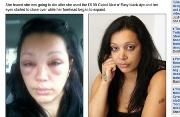 Selma pensou que fosse morrer ao ver seu rosto inchar 