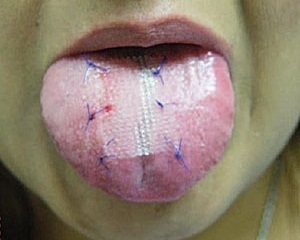 Foto mostra paciente com tela costurada na lngua.