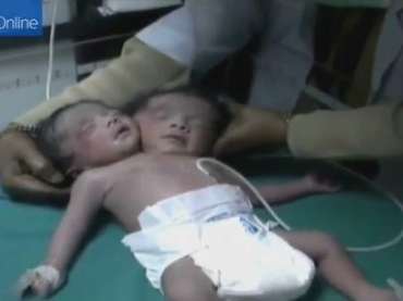 O beb� nasceu com duas cabe�as, dois pesco�os e duas espinhas, mas tem somente um corpo