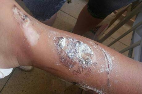 Menino ficou com uma ferida grave na perna