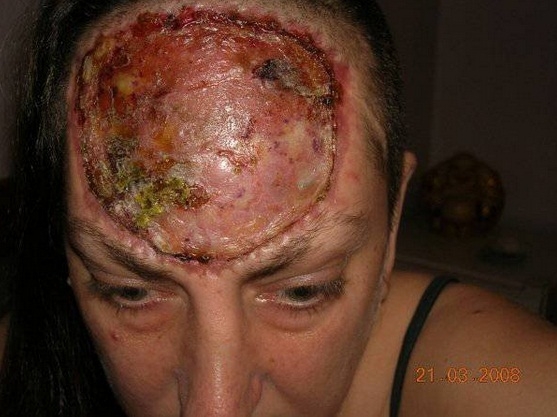 Mulher tem testa removida para vencer forma rarssima de cncer de pele