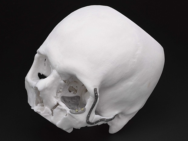 Exposio de implante no Museu de Cincias de Londres