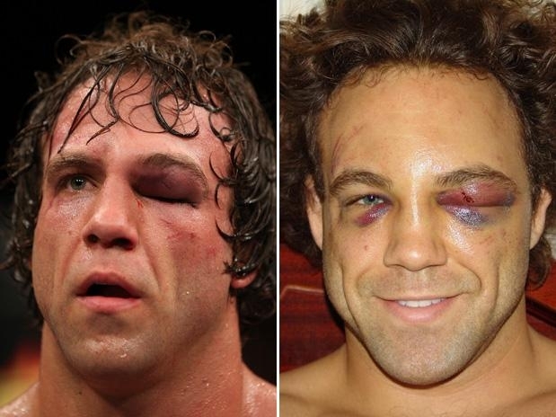 Kyle Kingsbury ficou bastante machucado na luta contra Manuwa